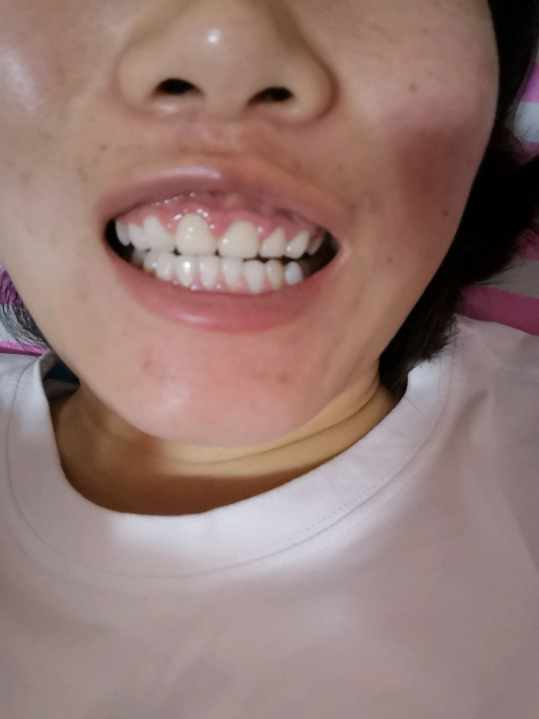 生活 生活美容  我是做的全瓷牙  四五个月后,做全瓷牙的牙龈都肿了