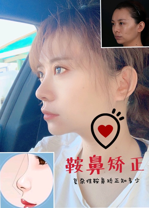 复杂性的鞍鼻如何矫正?复杂性鞍鼻实际上是面中1/3_圈子-新氧美容整形
