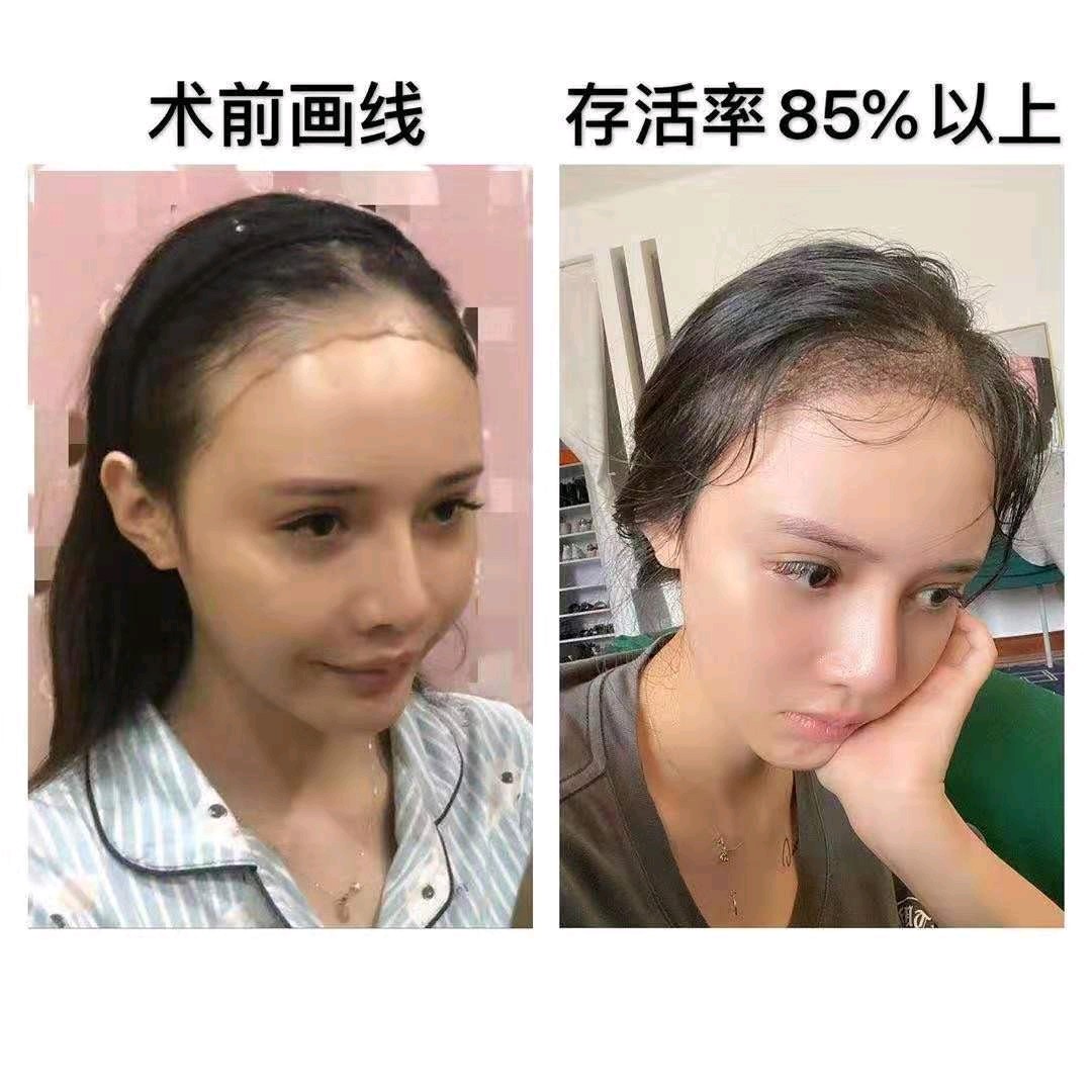 发际线让你年轻十岁93作为一个天生发际线高的女生