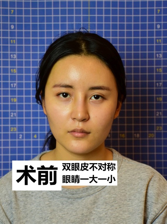双眼皮手术治好我的大小眼