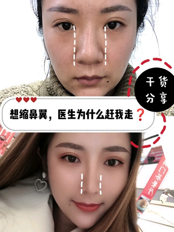 鼻翼整形干货分享:你真的适合做外切吗