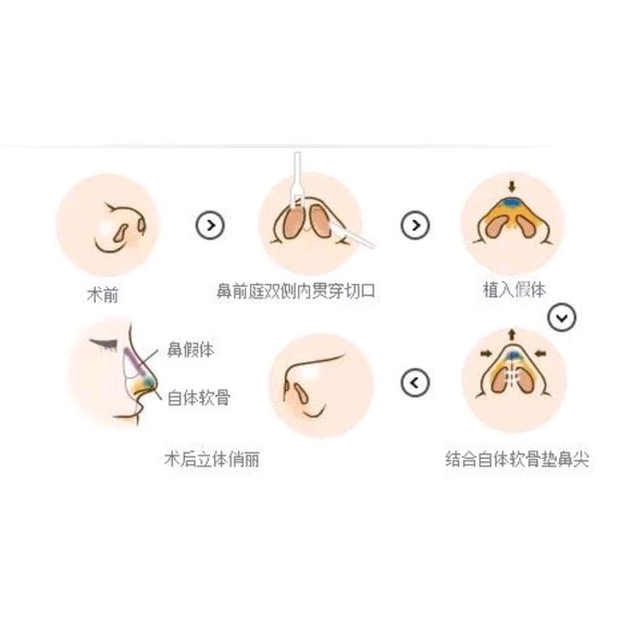 假体隆鼻手术,是将假体放置在鼻背软组织