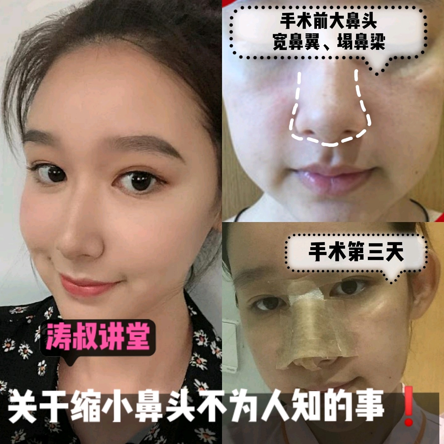 做完缩鼻头后,怎么越缩越大了