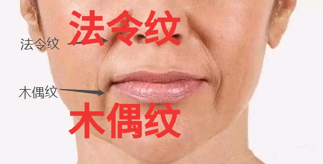 相比起法令纹,抬头纹,鱼尾纹,大家可能对木偶纹比较_圈子-新氧美容