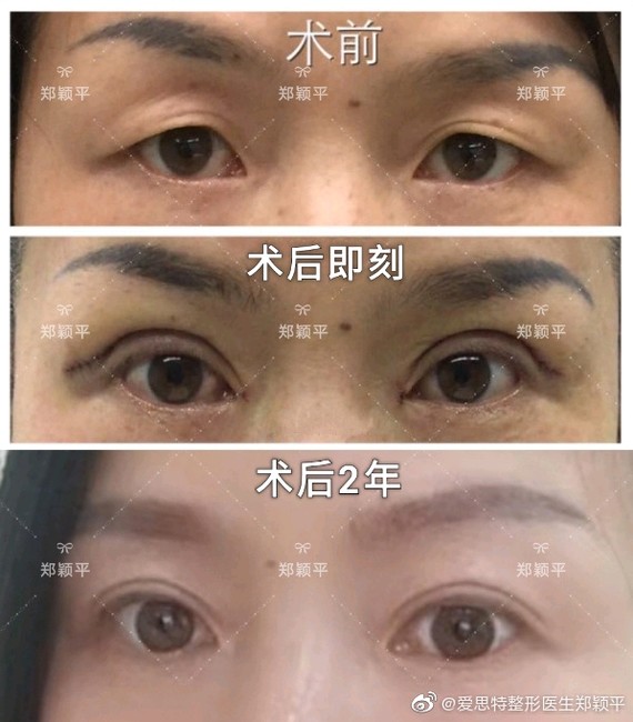 图中美女眼部年轻化精雕术后2年,上睑凹陷三角眼变成 温柔明亮有神眼.