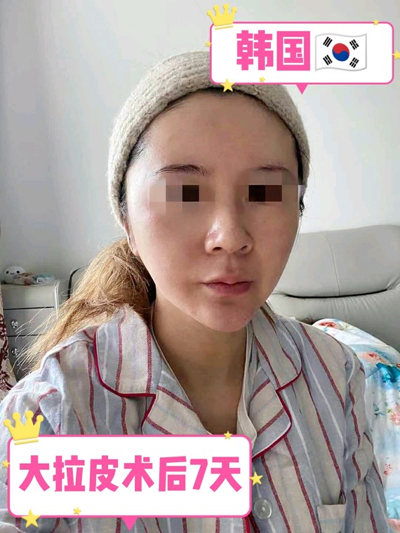 韩国大拉皮术后第7天大拉皮切口怎么比小拉皮切口要大