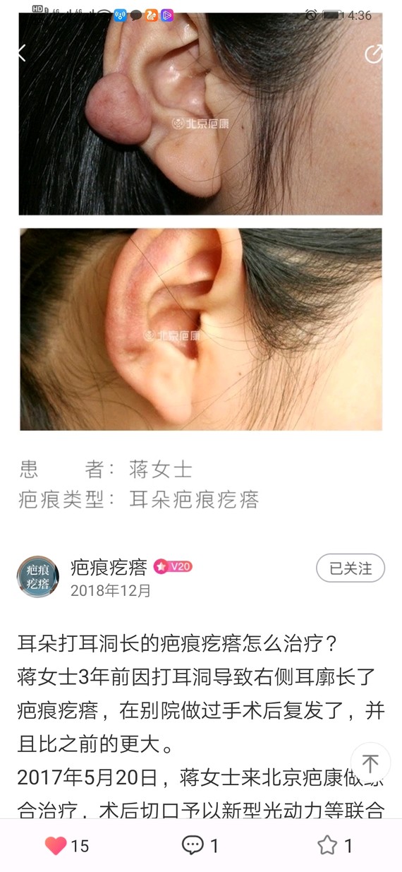 耳朵打耳洞长的疤痕疙瘩怎么治疗?