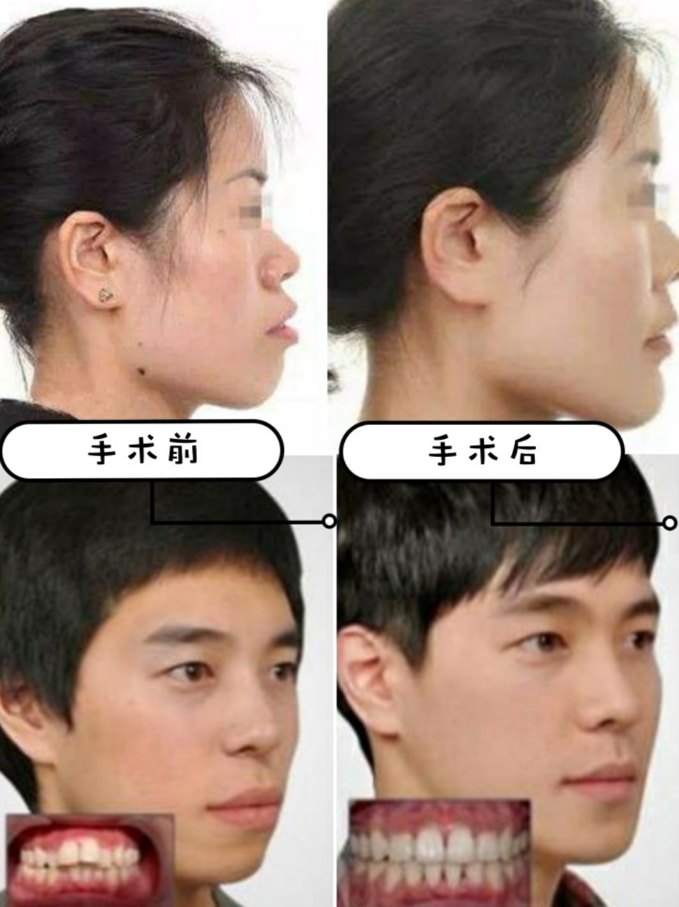 "龅牙妹"逆袭女神小妙招
