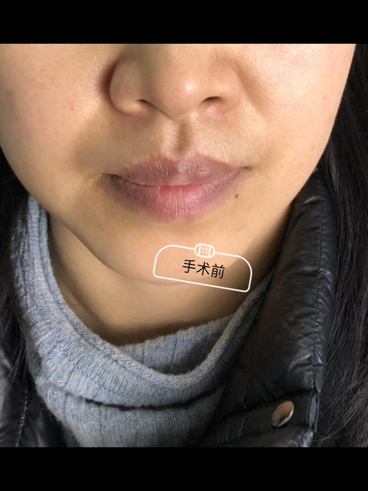 【唇部综合】桃心唇 m唇 唇珠 下唇手术丰唇 【王皓民
