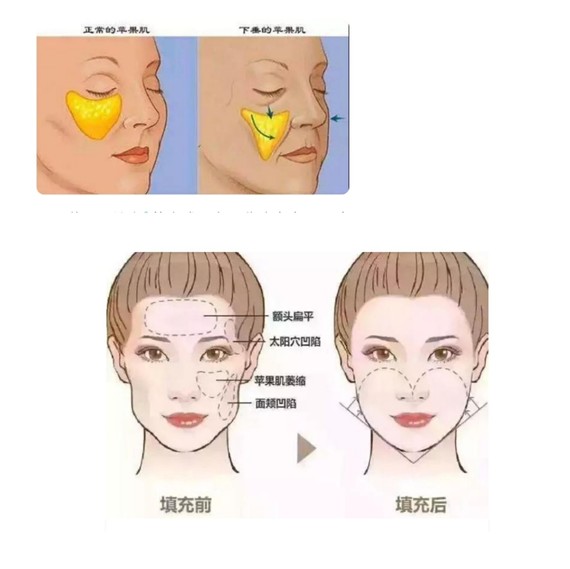 苹果肌的具体位置,大家可以看一下图三,在眼下两厘米左右,微笑或者做