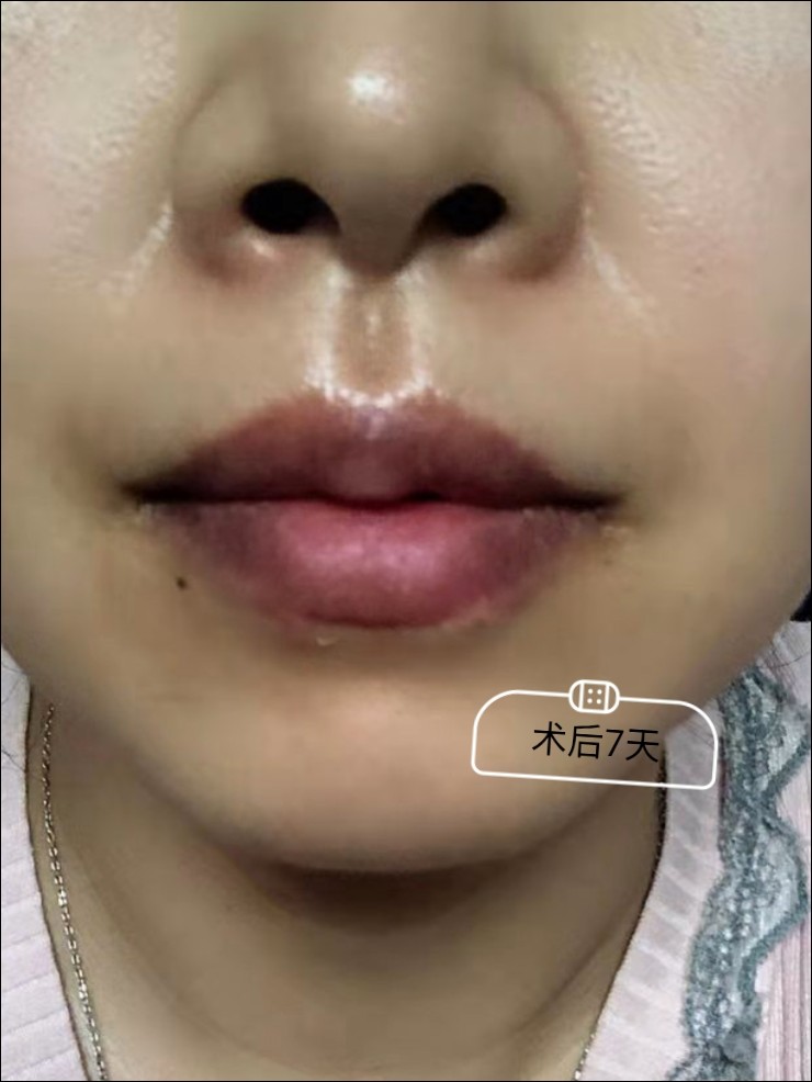 【唇部综合】桃心唇 m唇 唇珠 下唇手术丰唇 【王皓民