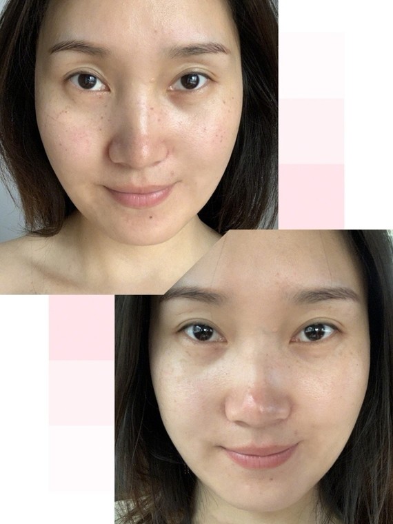 你知道如何避免做完光子嫩肤后的反黑吗?光子嫩肤作为