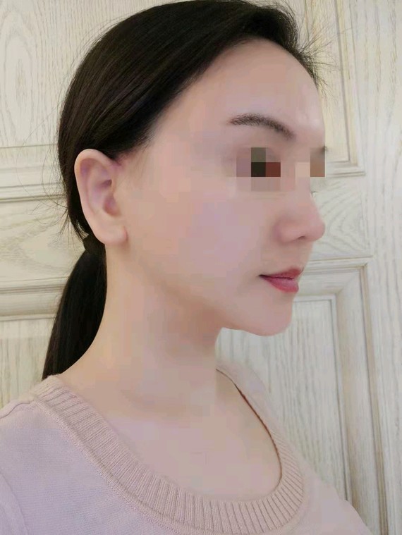 拿我拉皮手术对比照片说效果,做完大拉皮手术50天已