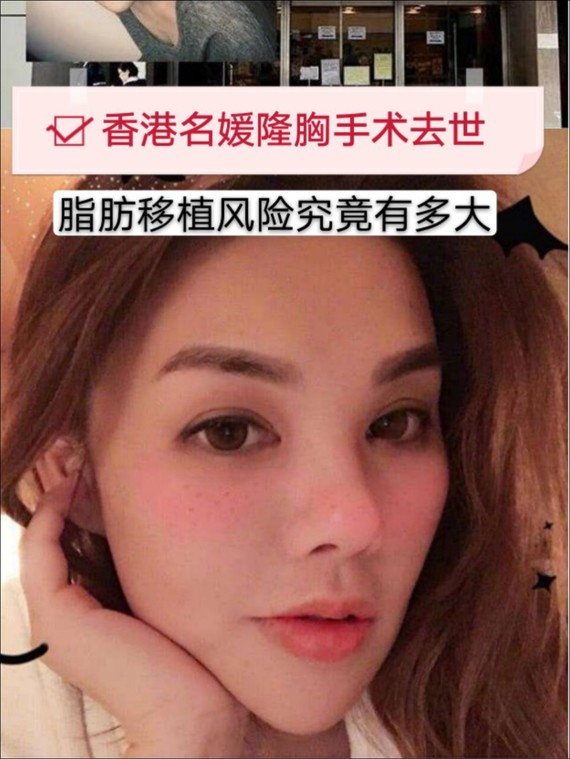 香港名媛隆胸手术去世6015脂肪移植风险究竟有不