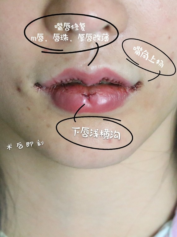 嘴唇修复,短厚唇变身baby微笑唇