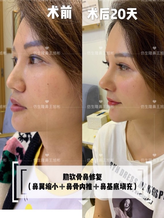 后20天, 同一个场景,同一个角度,同样高清对比图～ 鼻尖下垂"鹦鹉嘴"