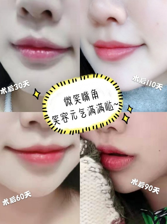 微笑唇案例分析