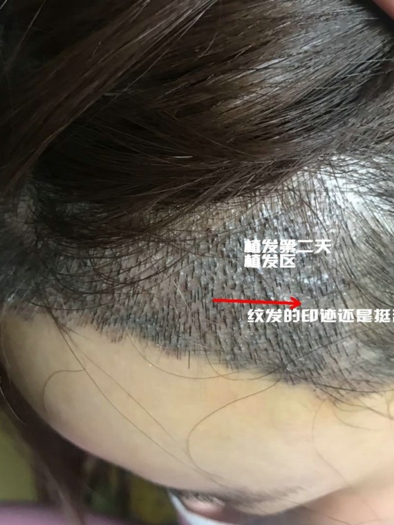 案例分享—纹发际线失败后植发的小仙女