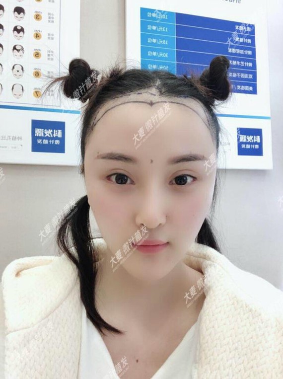 植发三个月啦!给大家分享一下