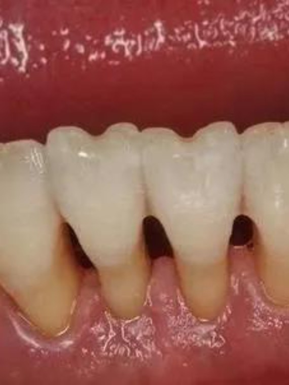 医生我牙龈萎缩怎么办?