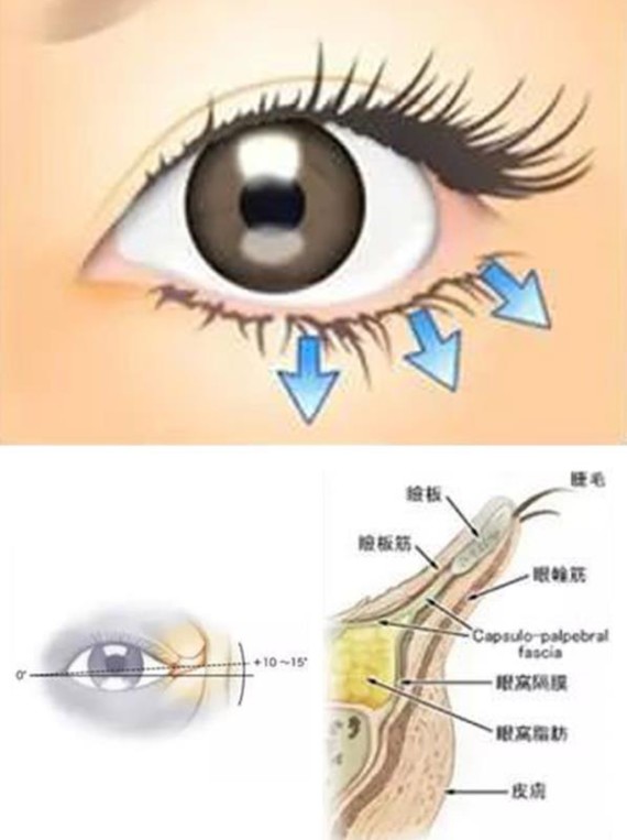 什么是下眼睑下至