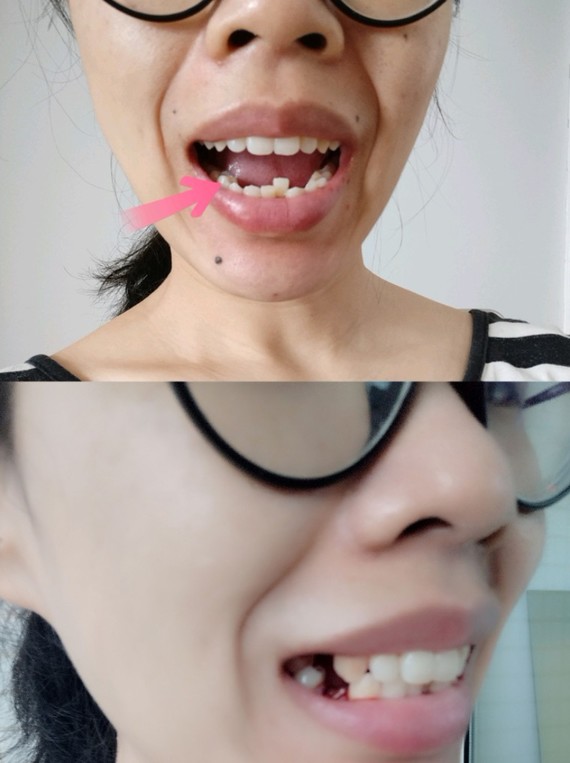 牙齿矫正‖如何判断自己需不需要拔牙?