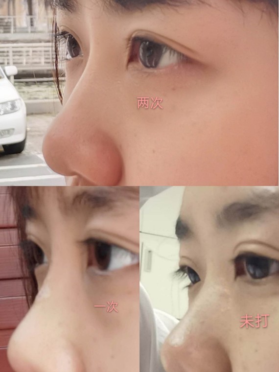 【爱贝芙隆鼻】