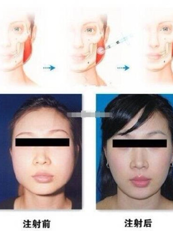还在为自己的咬肌发愁吗?瘦脸针帮助你实现瘦脸.