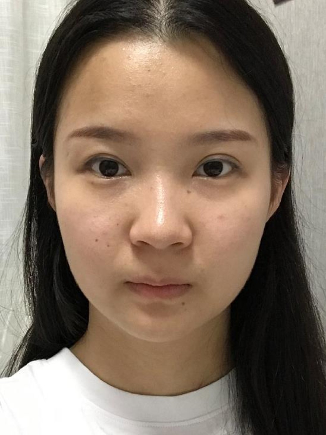 【硅胶隆鼻】韩式生科硅胶假体 ,解决鼻梁塌/鼻头大/鼻翼宽,弧线自然