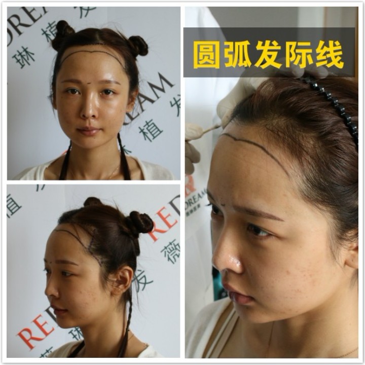 【案例分享】发际线种得好,秒变鹅蛋脸