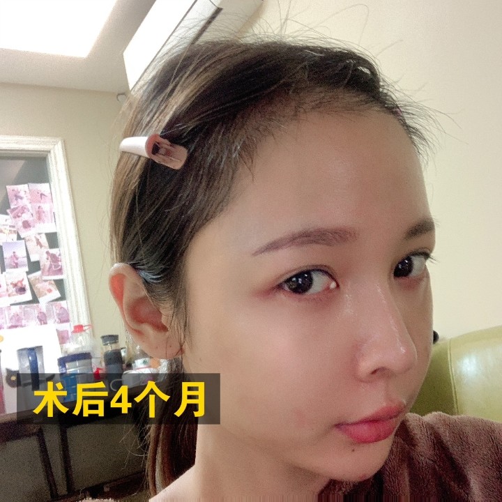 【案例分享】发际线种得好,秒变鹅蛋脸