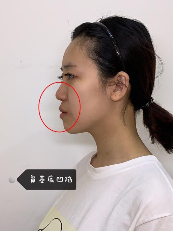 鼻基底凹陷严重,什么材料填充比较好?