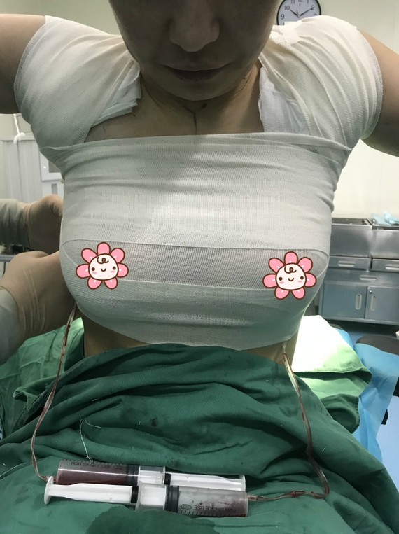 项目:内窥镜假体隆胸 抽副乳 假体品牌:曼托250cc 麻醉方式:全麻 手术