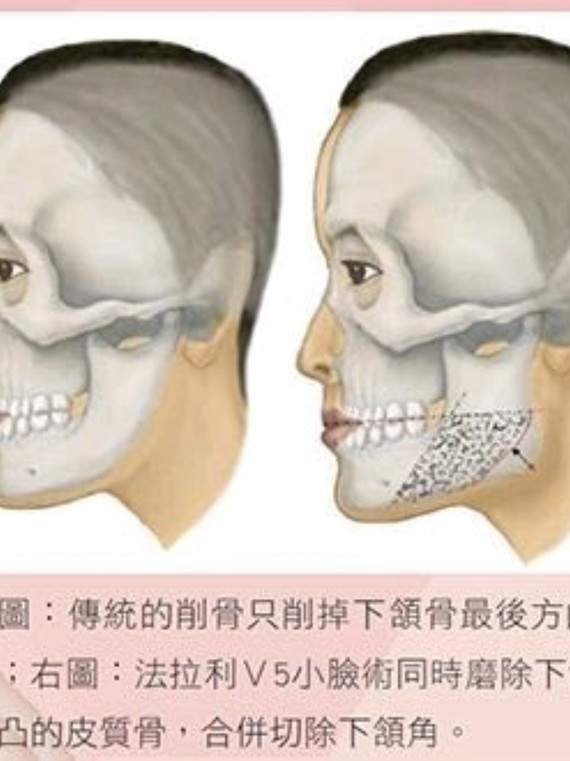 首先要明确咬肌的位置,咬肌是位于颧骨外侧颧弓与下颌角位置的一块