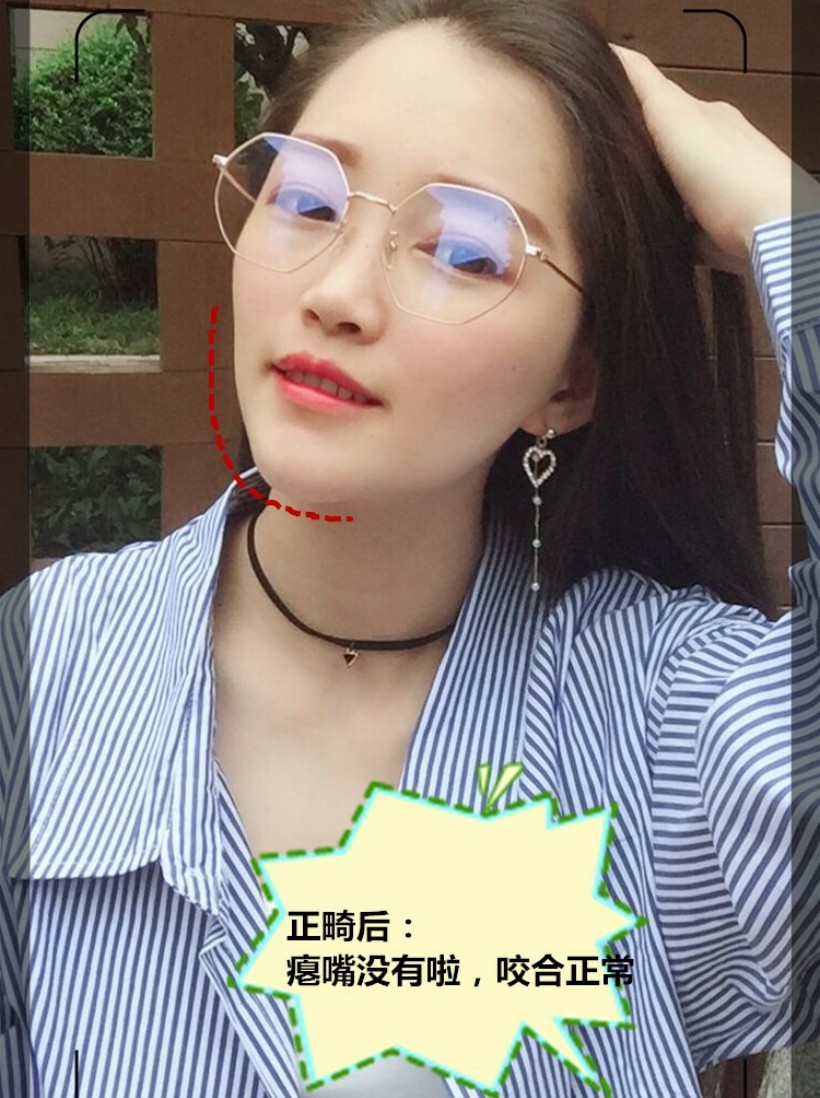 有的人看起来瘪嘴,下巴翘,一般的人并不容易发现这样的问题是由于