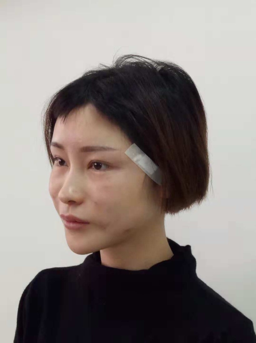 成都星美宝岛整形做的不可吸收全脸线雕(tbm线雕)埋线提升,想瘦脸与