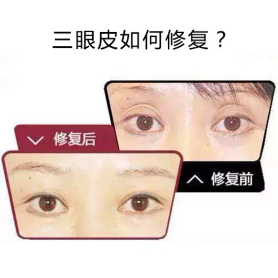 【整形科普】双眼皮修复后变三眼皮的主要原因总结