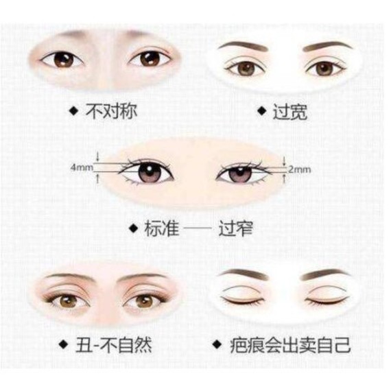【整形科普】双眼皮修复后变三眼皮的主要原因总结