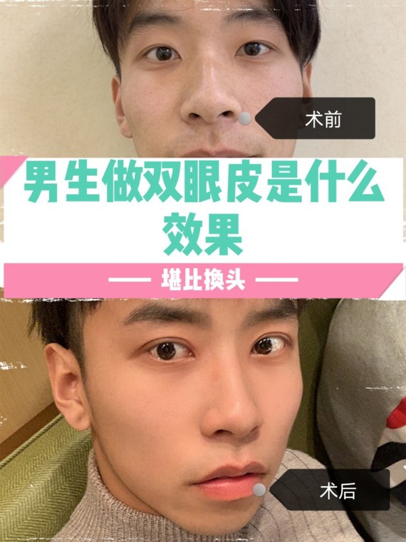 男生做双眼皮是什么效果?答:堪比换头!