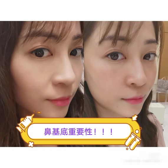 玻尿酸填充#玻_圈子-新氧美容整形