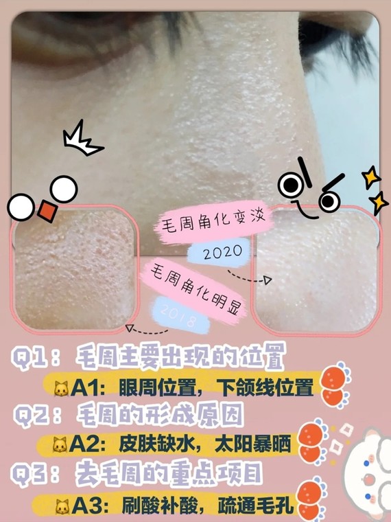 知道身上小疙瘩叫做鸡皮肤,然后长在脸上的鸡皮肤就是毛周角化,所以从