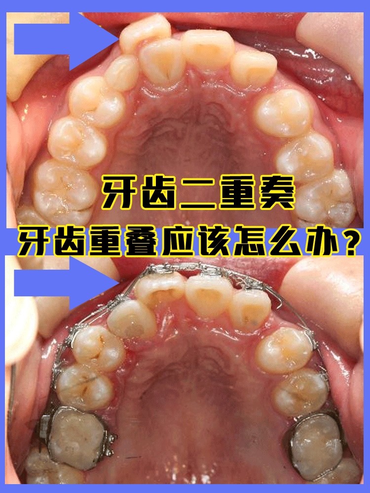 牙齿二重奏,牙齿重叠拥挤应该怎么办?