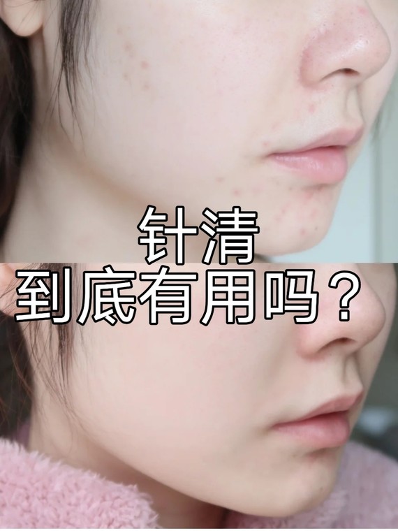 针清后肉眼可见的效果91针清后的日常护理#针清#医美_圈子-新氧美容