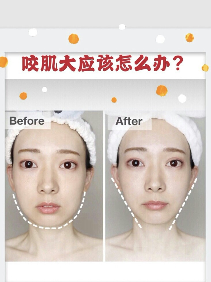 咬肌大应该要怎么办?