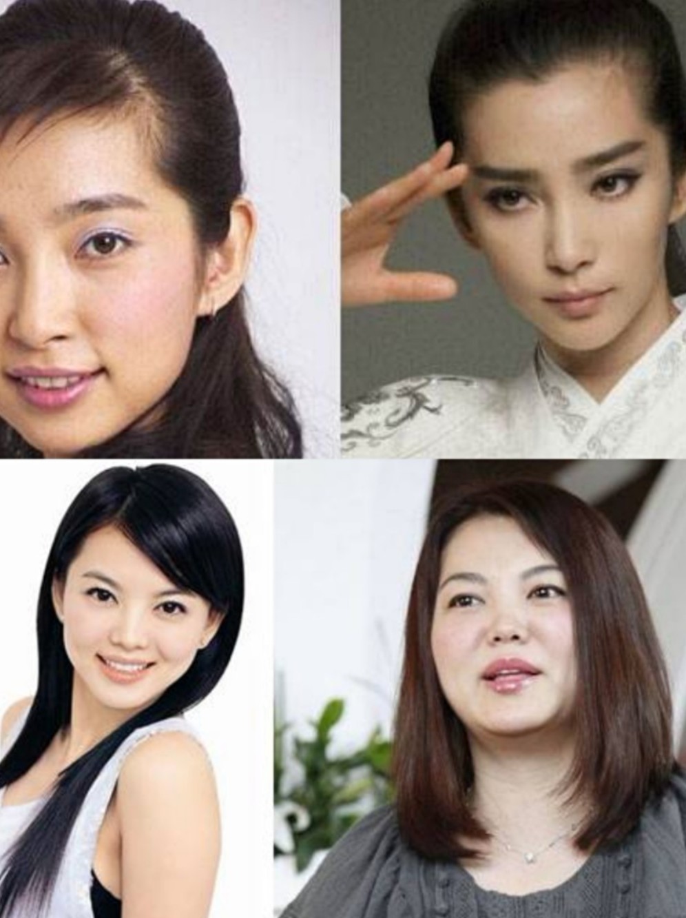 瘦脸针效果一,    咬肌肥大会让面部线条看起来过于僵硬,缺乏女性