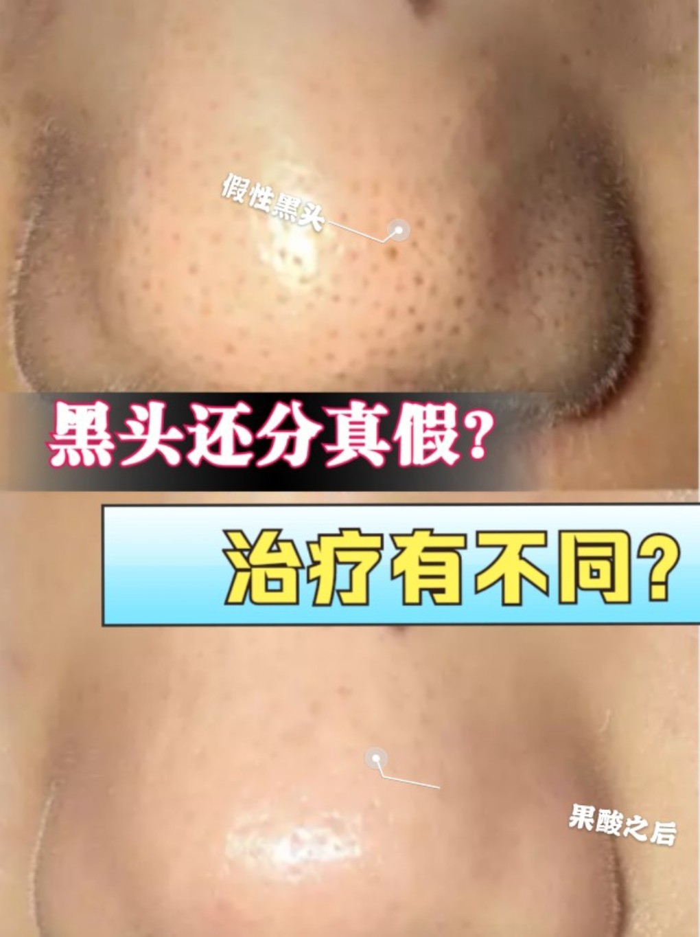 不同的黑头治疗也不同?你有啥样的黑头?