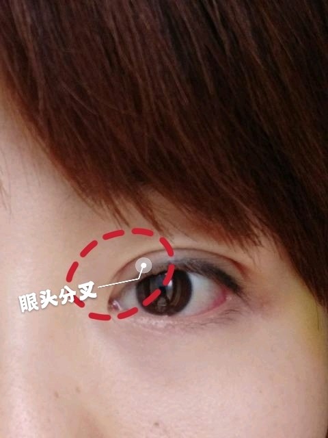 双眼皮分叉一般有两种情况:眼头分叉和眼尾分叉.