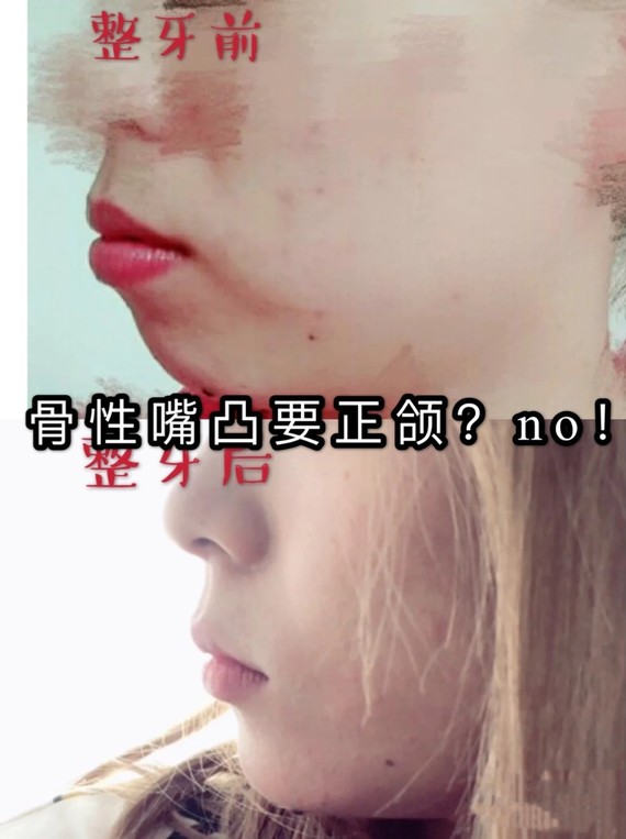 骨性嘴凸只能动骨71no7515现在最流行夸人长得好看,_圈子-新氧