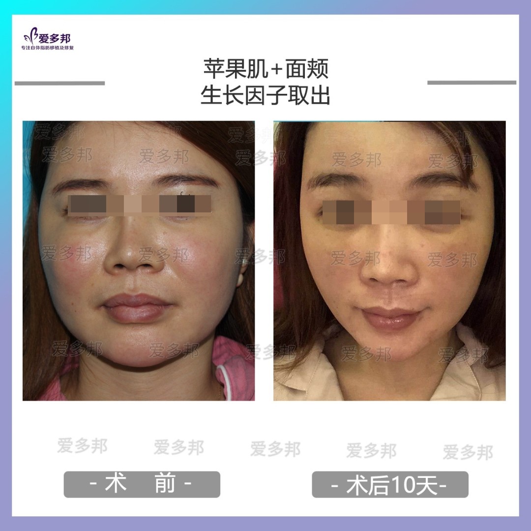 不明注射物取出#生长因子取出#奥美定取出