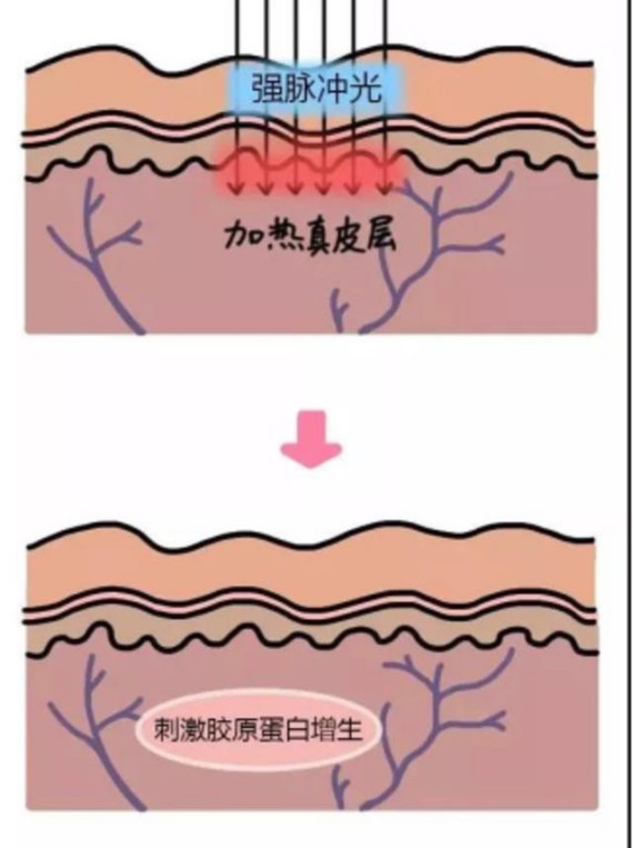 光子嫩肤通过选择性光热作用原理,破坏色素团,凝固血管,从而达到淡斑